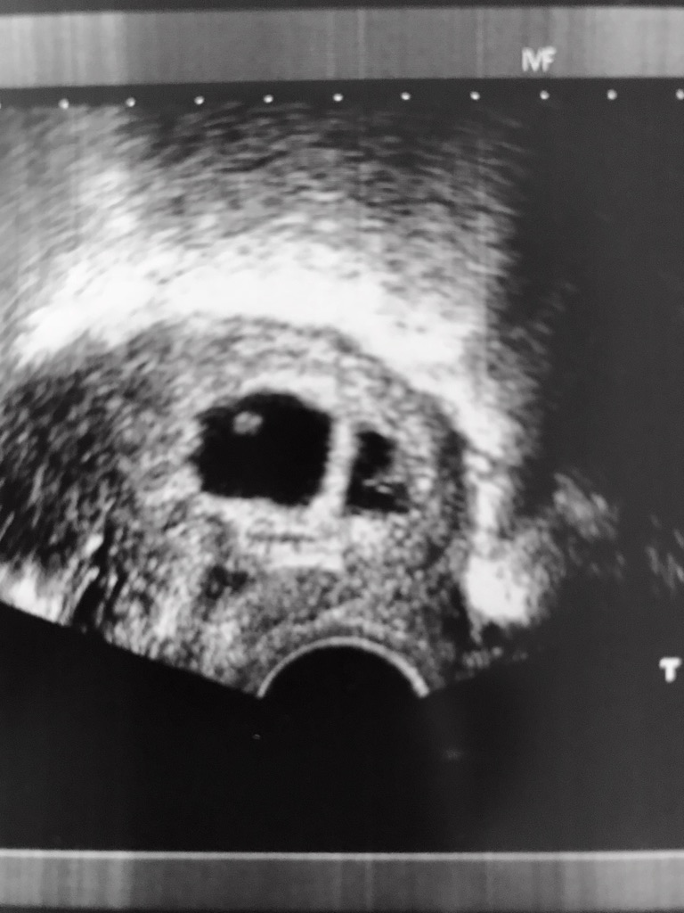 IVF successful embryo transfer ultrasound. Possible identical twin. 